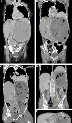 Case Report: Complete Necrosis of a Large Adrenocortical Cancer and Liver Metastases Achieved by Selective Arterial Embolization: A Case Study and Review of Literature